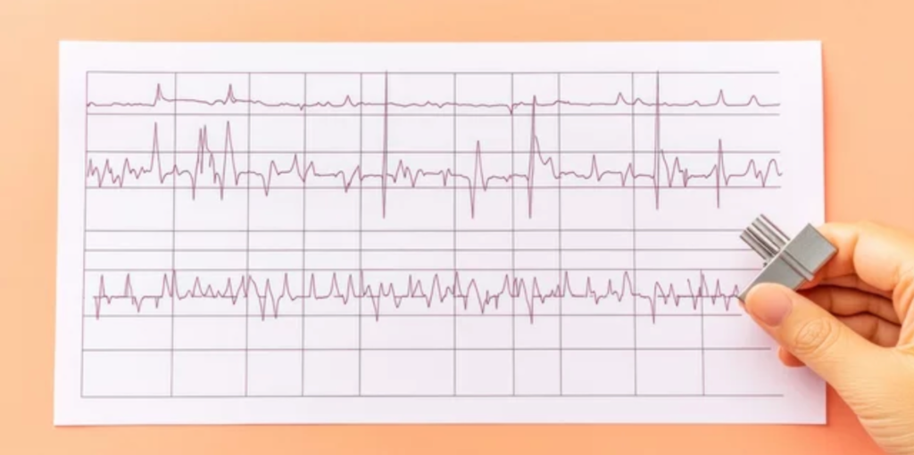 An ECG read out.